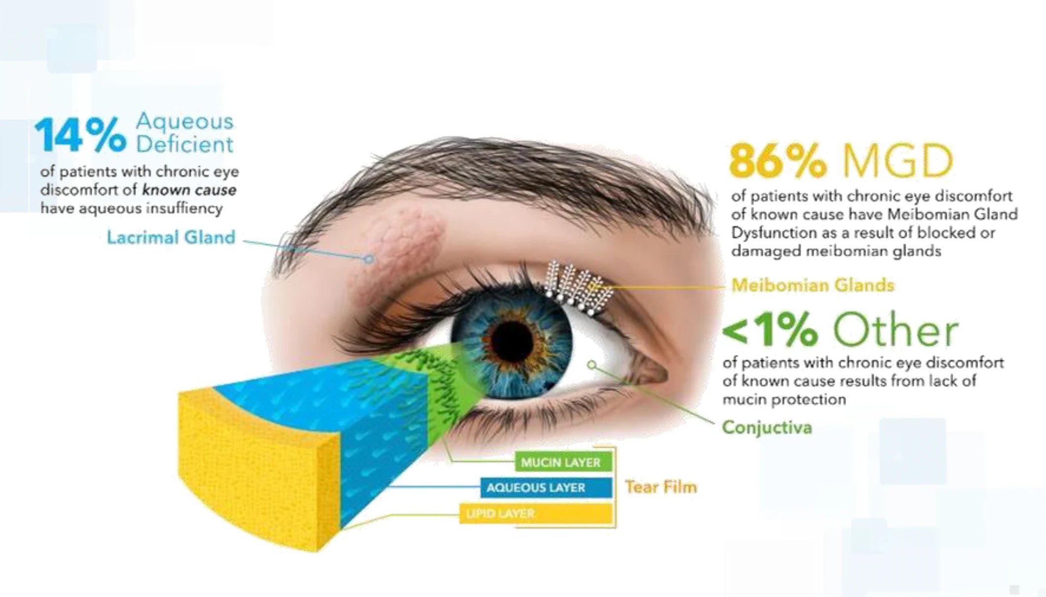 Dry Eyes Rochester Eye Laser Center Dry Eyes Rochester Eye Laser Center